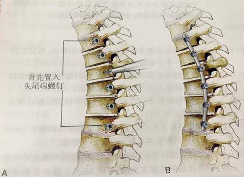 腰椎前路椎体切除术手术技巧