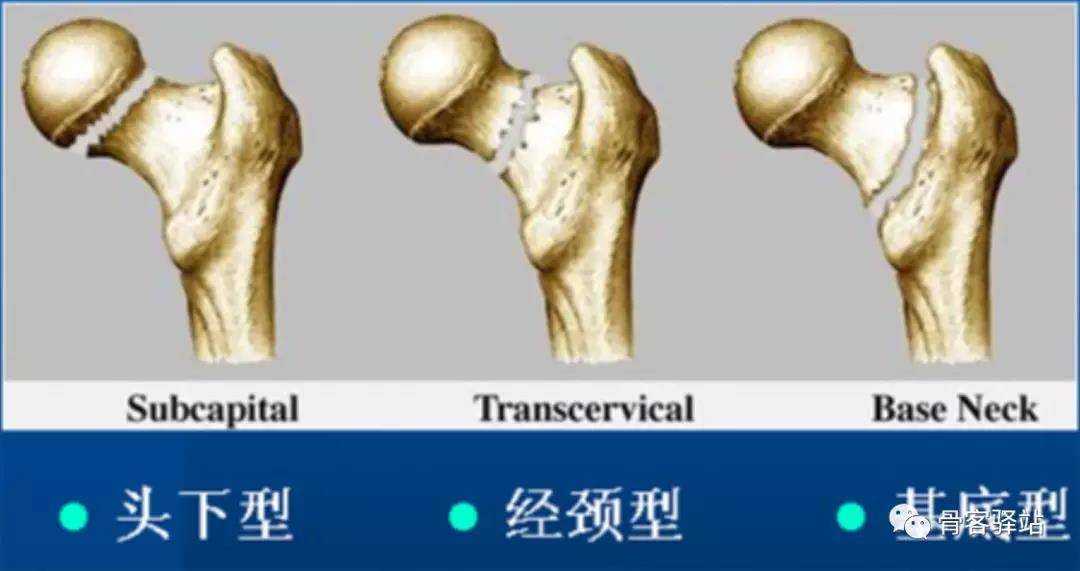 髋关节疾病常见分型汇总,值得收藏!