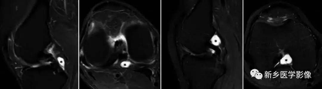千万别把这个误诊为"膝关节腔积液"